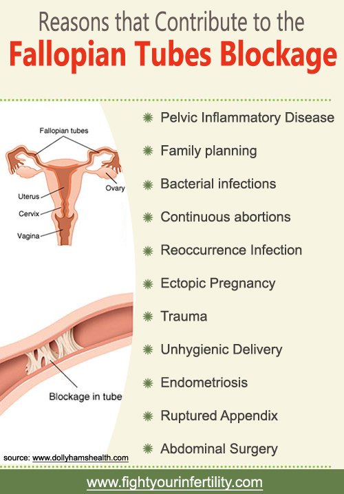 Pregnant In Fallopian Tube 43